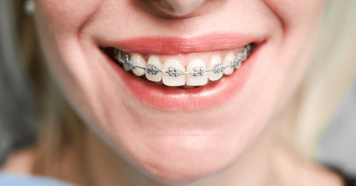ceramic braces