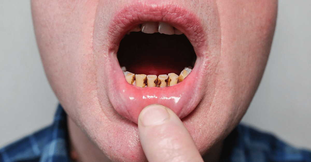 black teeth