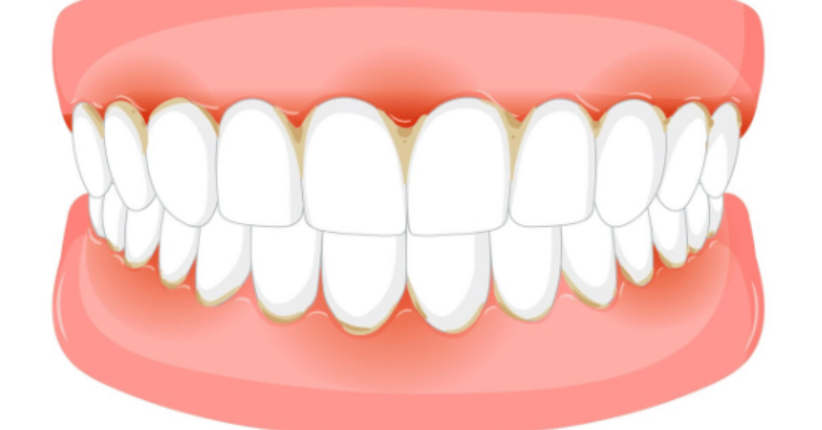 gap teeth