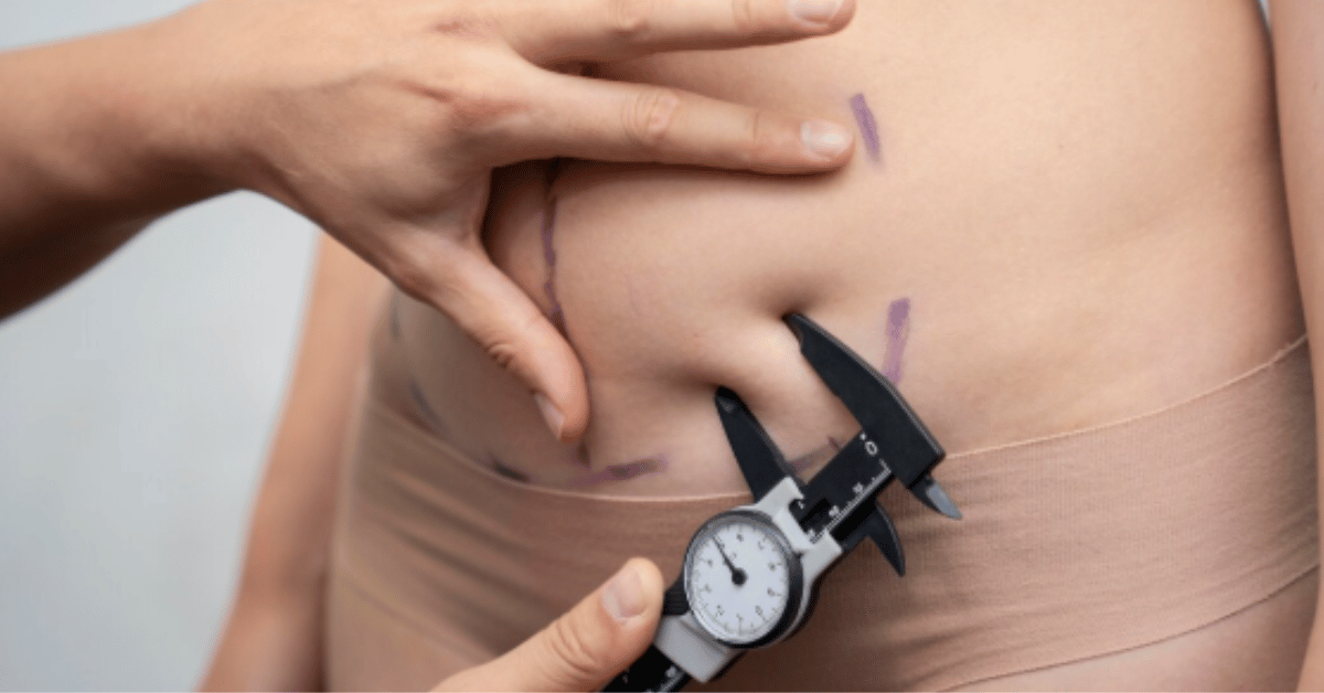 liposuccion